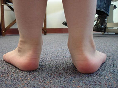 Все дети рождаются с наличием физиологического плоскостопия, которое исчезает по мере роста и развития малыша. Но бывают случаи, что у ребенка к 4 — 5 годам развивается плосковальгусная деформация стопы. Причины появления плоскостопия довольно разнообразны.